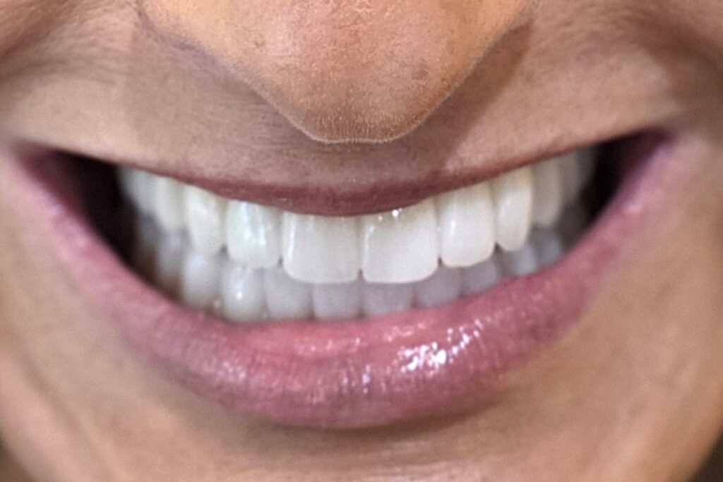 Post-Smile1