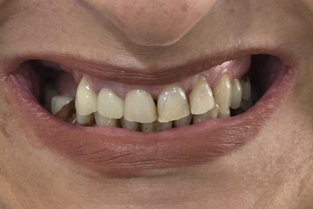 Pre-Smile